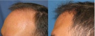 Hair Transplant