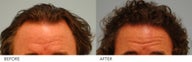 Hair Transplant