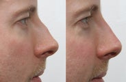 Rhinoplasty