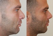 Revision Rhinoplasty Surgery