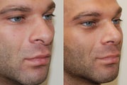 Revision Rhinoplasty
