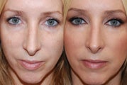Lower eyelid rejuvenation with Silikon-1000