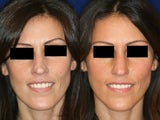 Non-Surgical Rhinoplasty