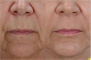 Fractional Resurfacing