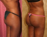 buttock augmentation