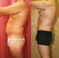 Male abdominoplasty or tummy tuck