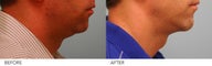 Chin Implant and Neck Liposuction