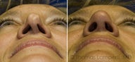 Revision Rhinoplasty with ear cartilage grafting