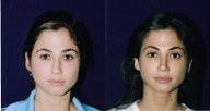 Rhinoplasty and Septoplasty