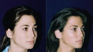 Rhinoplasty and Septoplasty