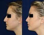 Rhinoplasty and Septoplasty