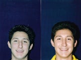 Rhinoplasty and Septoplasty