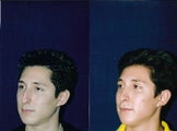 Rhinoplasty and Septoplasty