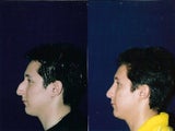 Rhinoplasty and Septoplasty