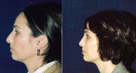 Rhinoplasty and Septoplasty