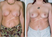 Mastopexy-Breast Lift