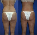 Liposuction