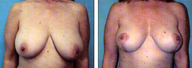 Breast lift