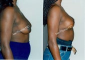 Mastopexy-Breast Lift