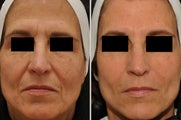 Restylane