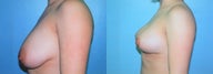 Vertical Mastopexy (Breast Lift with Nipple Reduction)