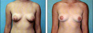 Breast lift