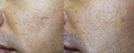 Acne Scar Treated with Sculptra