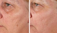 Active FX Fractional Laser Resurfacing