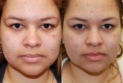 Correction of Acne Scarring with Silikon-1000