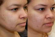 Correction of Acne Scarring with Silikon-1000