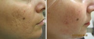 Fractional Resurfacing Acne Scars