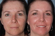 Subcison and Fraxel Repair Acne Scar Treatment