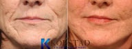 Dermabrasion