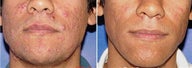 Photodynamic Therapy (PDT) Acne Treatment