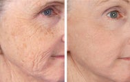 Active FX Fractional Laser Resurfacing