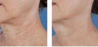 Active FX Fractional Laser Resurfacing