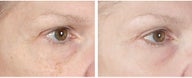 Active FX Fractional Laser Resurfacing