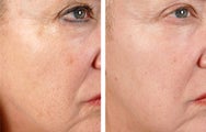 Active FX Fractional Laser Resurfacing