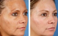 Active FX Fractional Laser Resurfacing