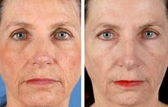 Active FX Fractional Laser Resurfacing