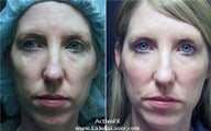 Active FX Fractional Skin Resurfacing