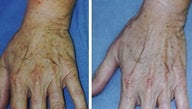Hand age spot removal by laser treatment