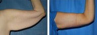 Arm lift