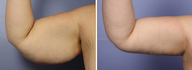 Arm Lift