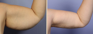 Arm Lift