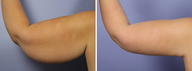 Arm Lift