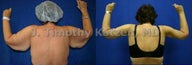 Before and after picture arm lift arm reduction after massive weight loss gastric bypass female