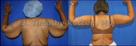 Before and after picture arm lift arm reduction after massive weight loss gastric bypass female african american back view