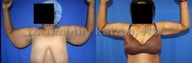 Before and after picture arm lift arm reduction after massive weight loss gastric bypass female african american frontal