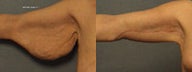 Brachioplasty (Arm Lift)